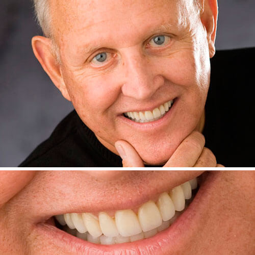 A collage of before and after a patient's restored smile