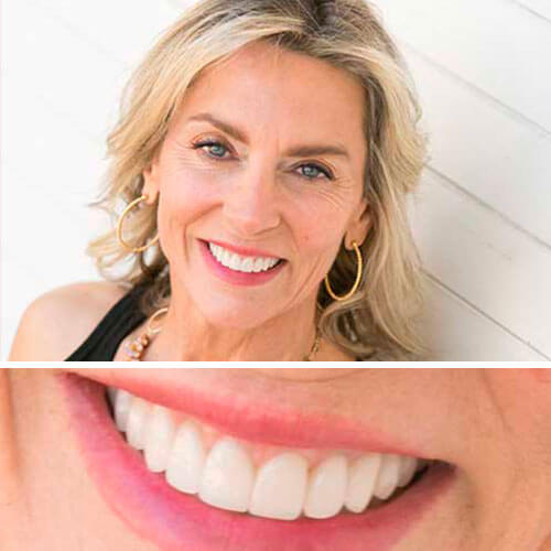 A collage of before and after a patient's restored smile